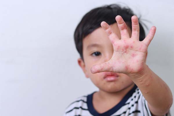 Kind mit Hautausschlag an der Hand.